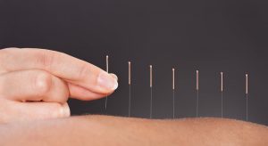 Acupuncture-Brisbane