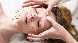 Acupuncture-in-Brisbane
