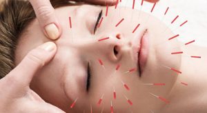 Acupuncture-Brisbane